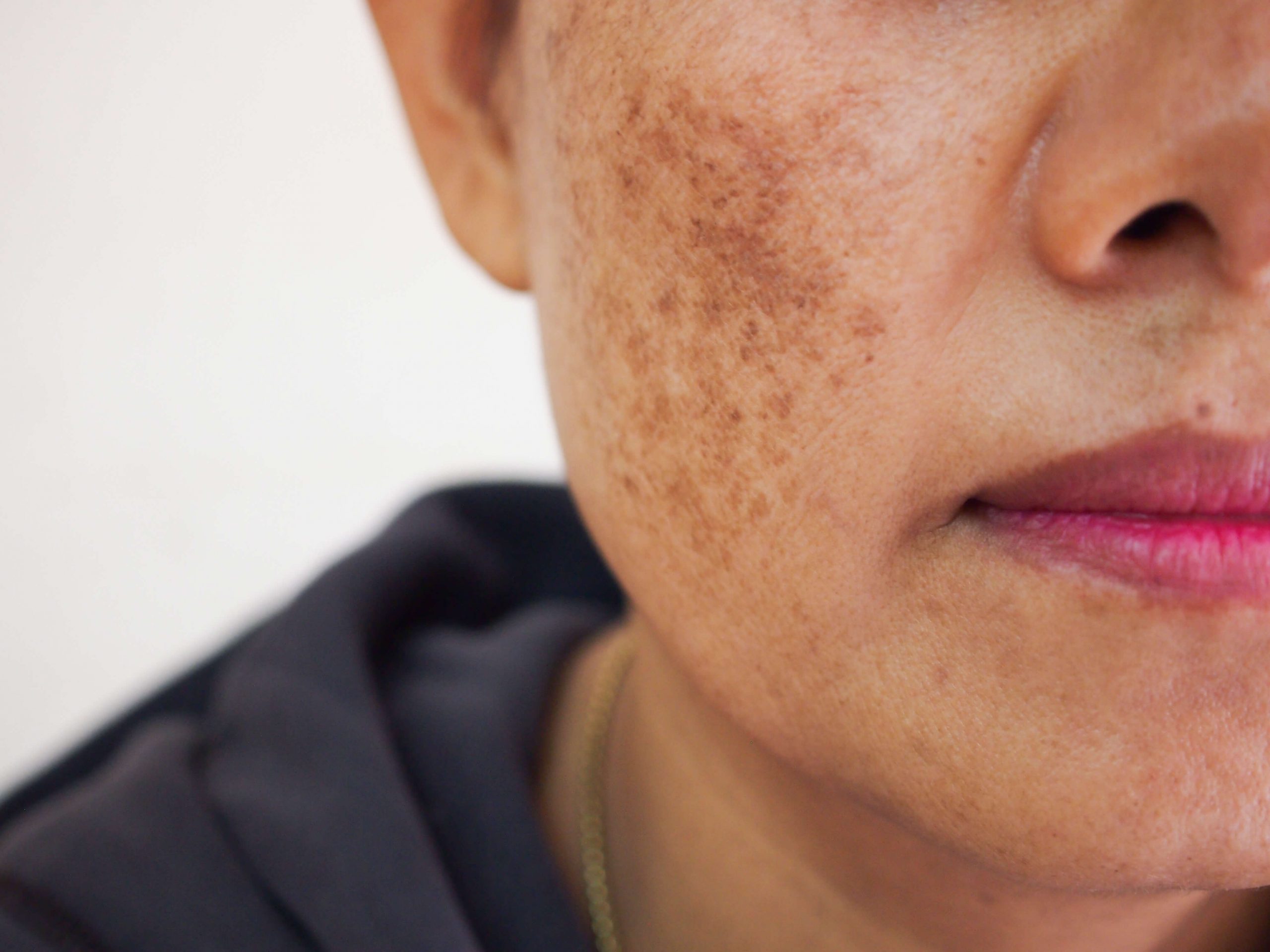 Tratamiento del melasma y las manchas faciales tras el verano